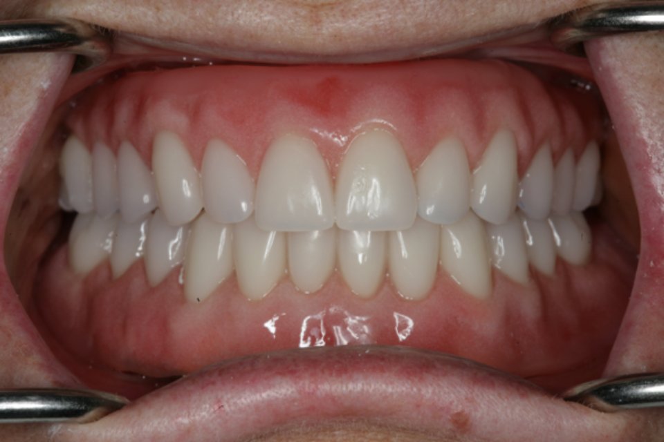 A patient’s new smile after an All-on-4 remake with Dr Dunn