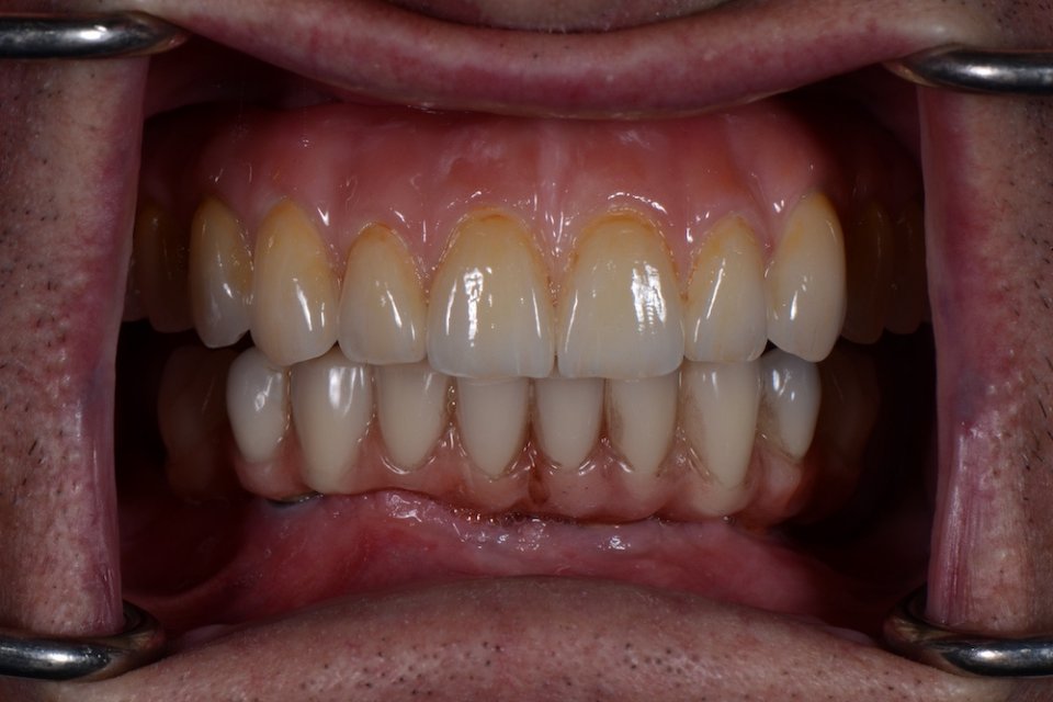 A patient’s teeth after an All-on-4 remake at Macquarie Street Centre