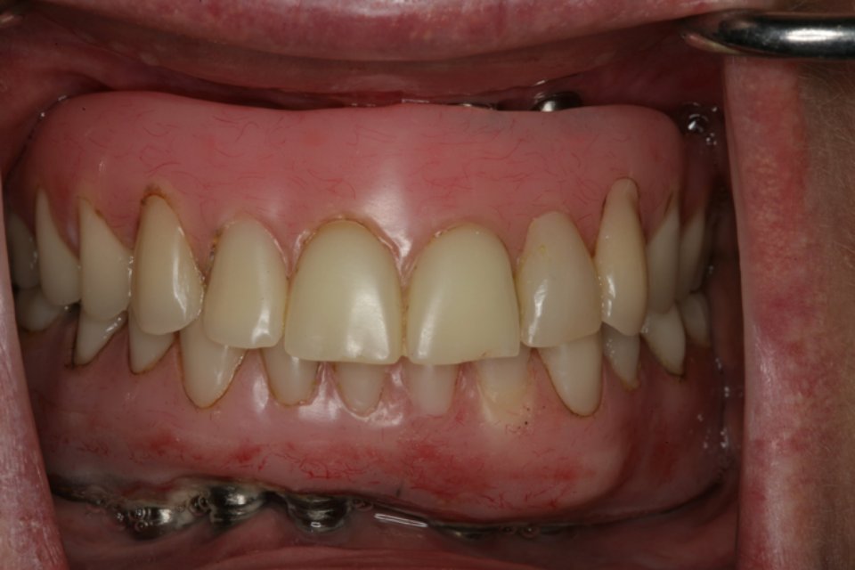 A stained and worn down All-on-4 tooth bridge