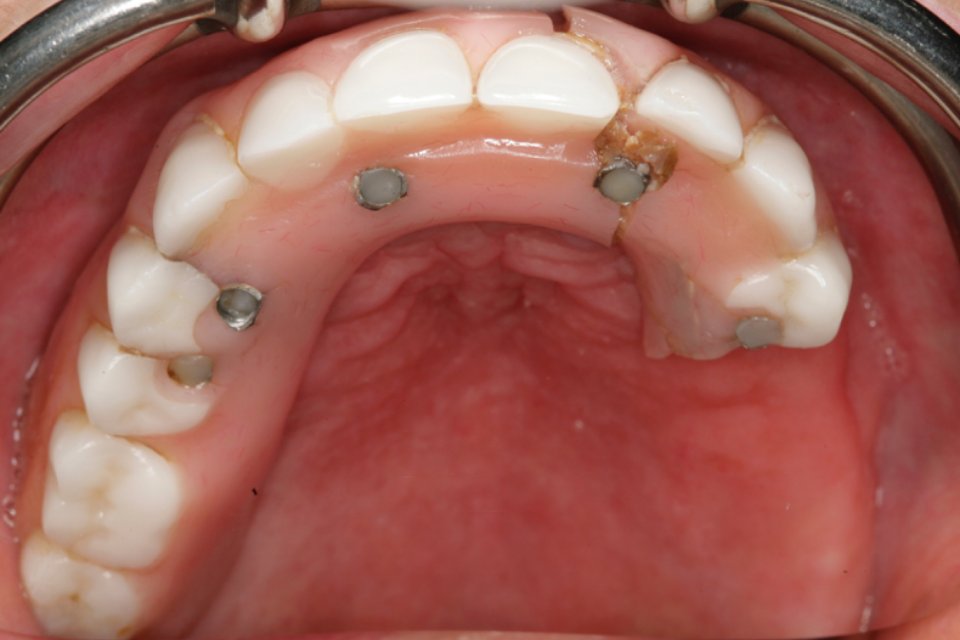 A failed All-on-4 tooth bridge with the back teeth broken off