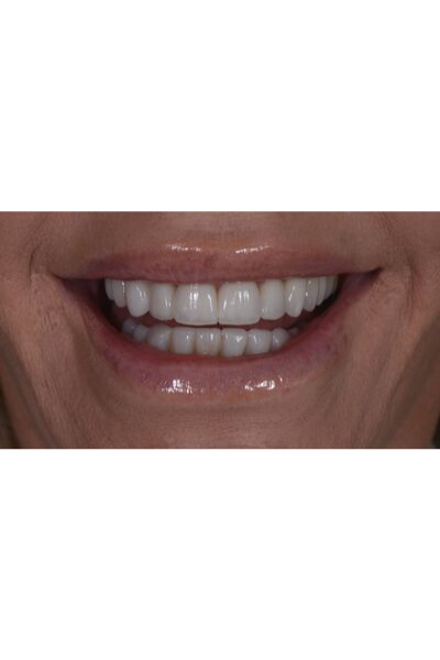 Before and after dental crowns image of an actual patient treated by Dr David Dunn at Macquarie Street Dental in Sydney