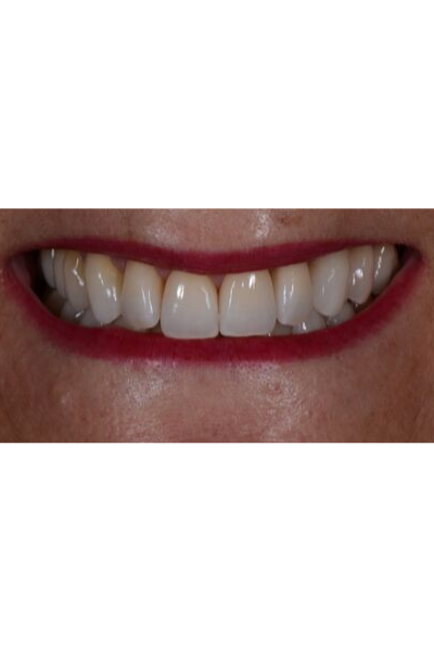 Before and after porcelain veneers image of an actual patient treated by Dr David Dunn at Macquarie Street Dental in Sydney