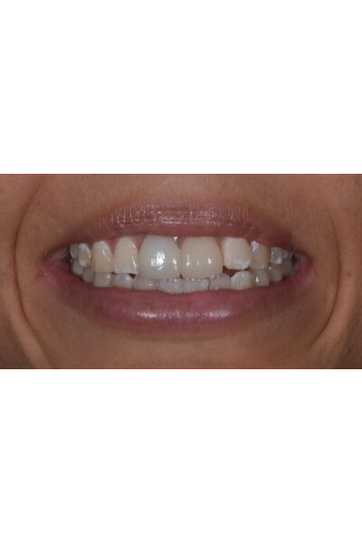 Before and after dental crowns image of an actual patient treated by Dr David Dunn at Macquarie Street Dental in Sydney